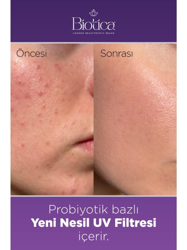 Biotica Microbiotic Acne Treatment Face-Up Serum 20 ml - Görsel 3